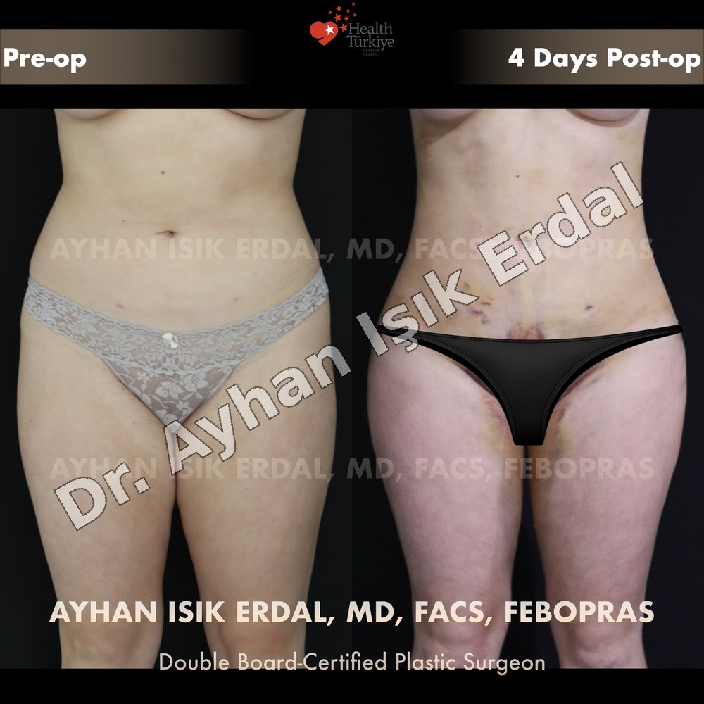Brazilian Butt Lift (BBL) before-and-after result by Dr. Ayhan Işık Erdal, Istanbul