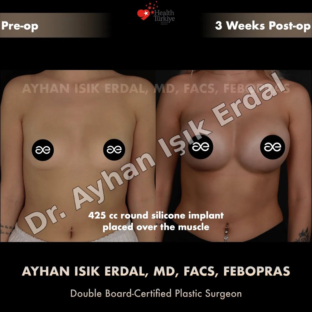 Breast Augmentation before-and-after result by Dr. Ayhan Işık Erdal, Istanbul