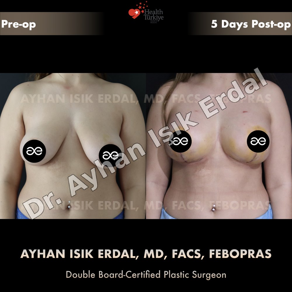 Breast Lift before-and-after result by Dr. Ayhan Işık Erdal, Istanbul