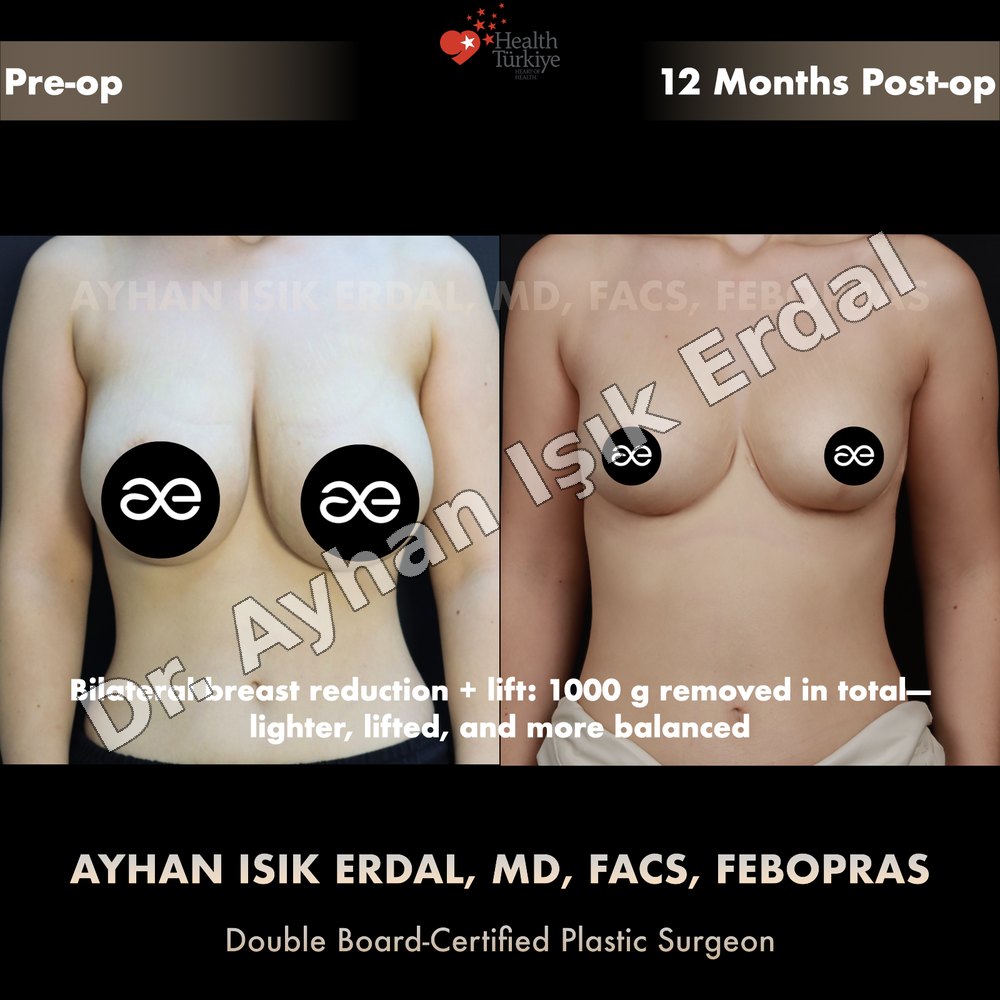 Breast Lift before-and-after result by Dr. Ayhan Işık Erdal, Istanbul