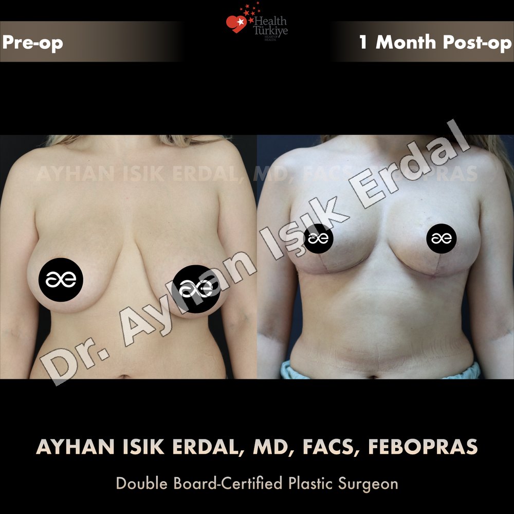 Breast Reduction before-and-after result by Dr. Ayhan Işık Erdal, Istanbul