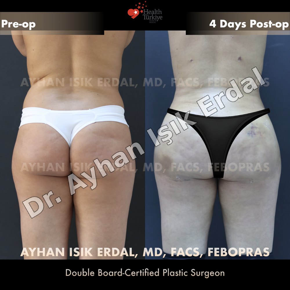 Liposuction before-and-after result by Dr. Ayhan Işık Erdal, Istanbul
