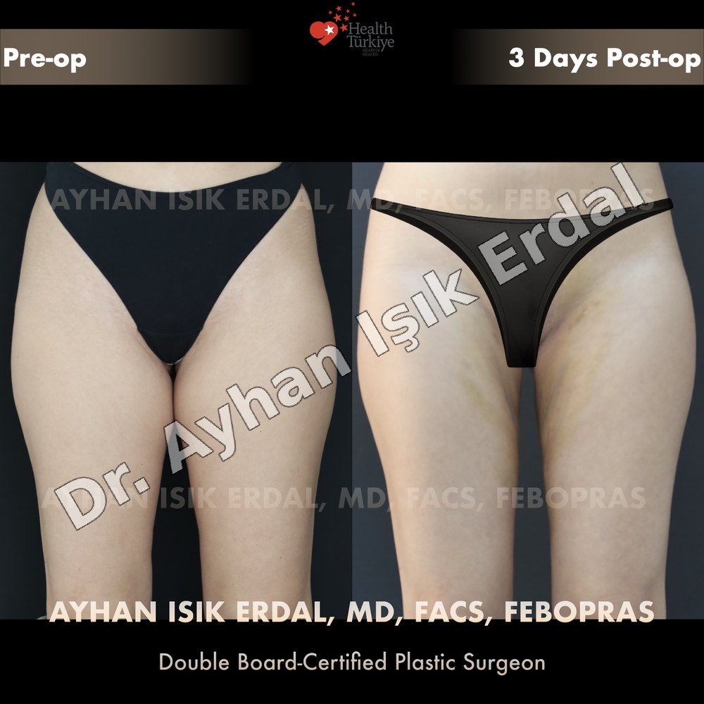 Liposuction before-and-after result by Dr. Ayhan Işık Erdal, Istanbul
