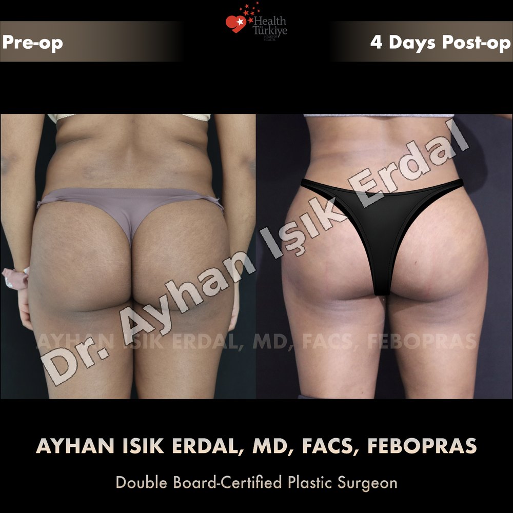Liposuction before-and-after result by Dr. Ayhan Işık Erdal, Istanbul