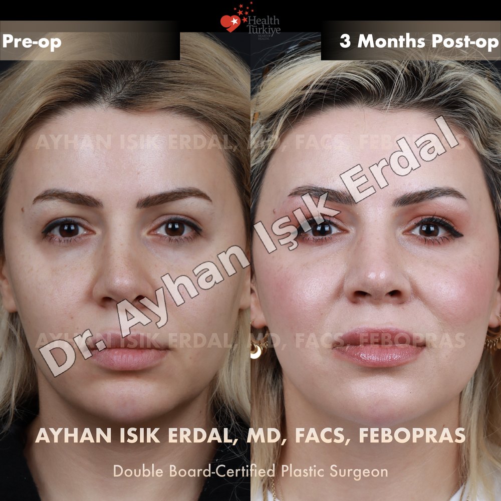 Revision Rhinoplasty before-and-after result by Dr. Ayhan Işık Erdal, Istanbul