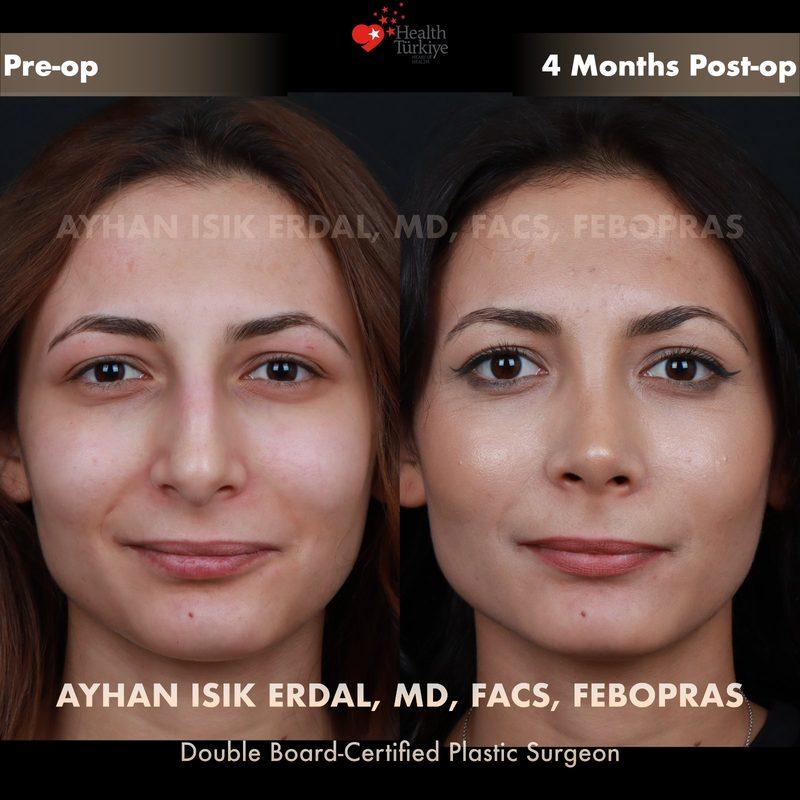 Rhinoplasty before-and-after result by Dr. Ayhan Işık Erdal, Istanbul