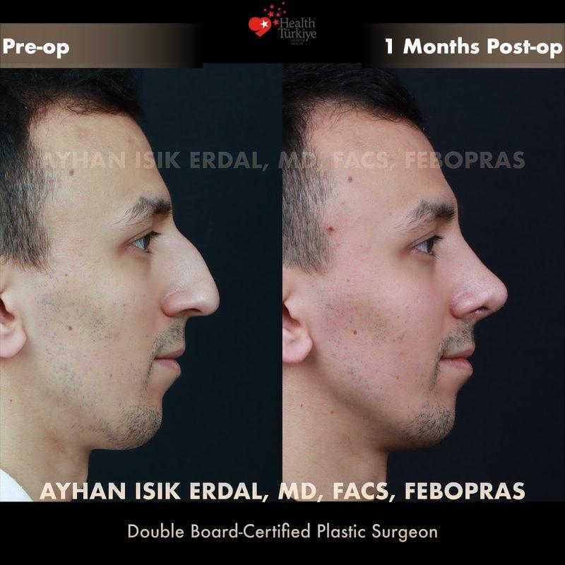 Rhinoplasty before-and-after result by Dr. Ayhan Işık Erdal, Istanbul