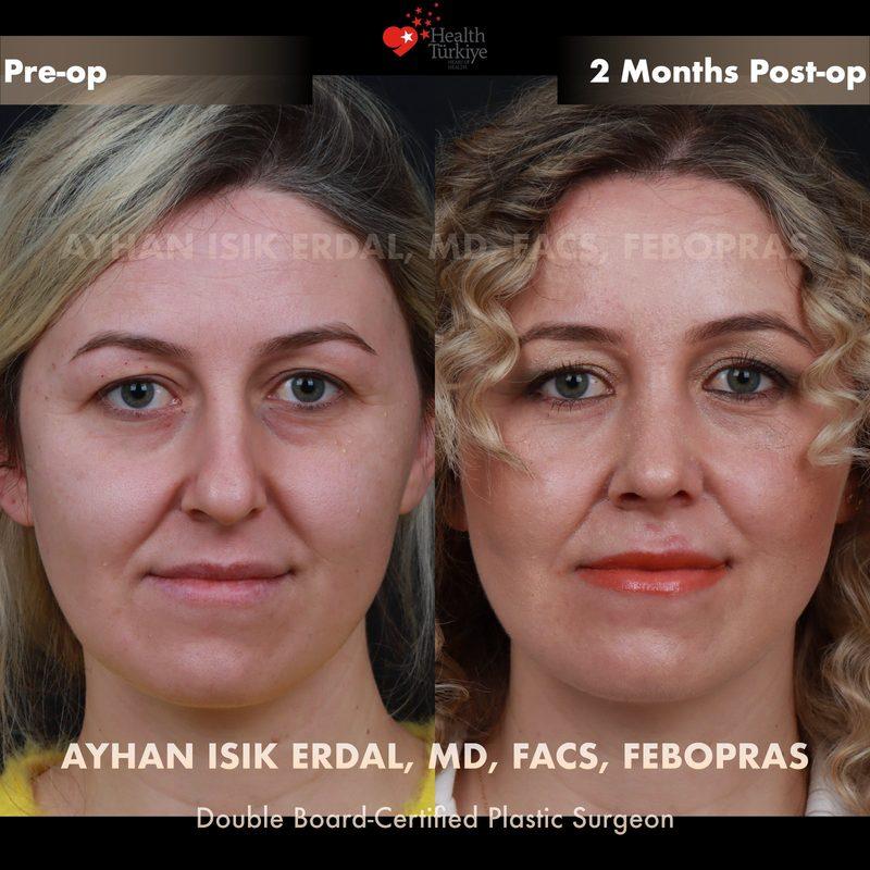 Rhinoplasty before-and-after result by Dr. Ayhan Işık Erdal, Istanbul