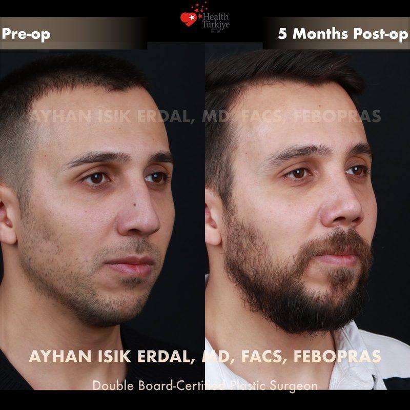 Rhinoplasty before-and-after result by Dr. Ayhan Işık Erdal, Istanbul