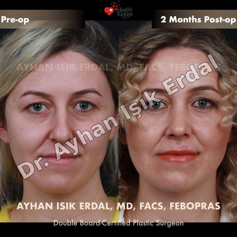 Rhinoplasty before-and-after result by Dr. Ayhan Işık Erdal, Istanbul