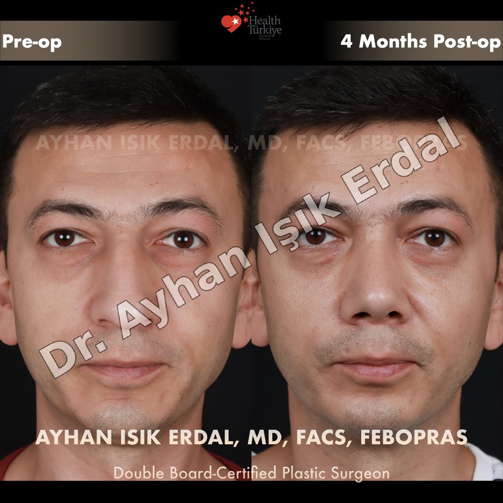Rhinoplasty before-and-after result by Dr. Ayhan Işık Erdal, Istanbul