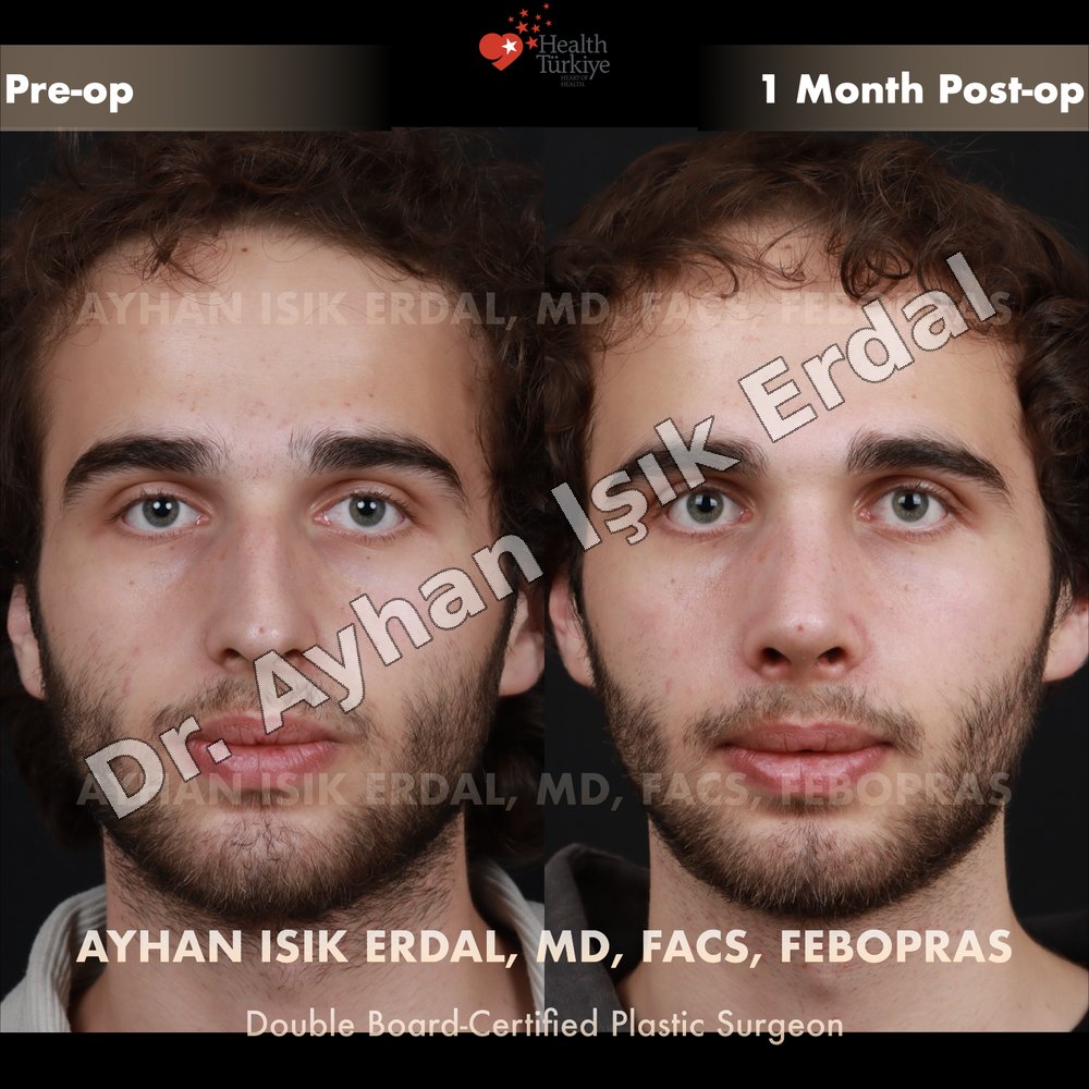 Rhinoplasty before-and-after result by Dr. Ayhan Işık Erdal, Istanbul