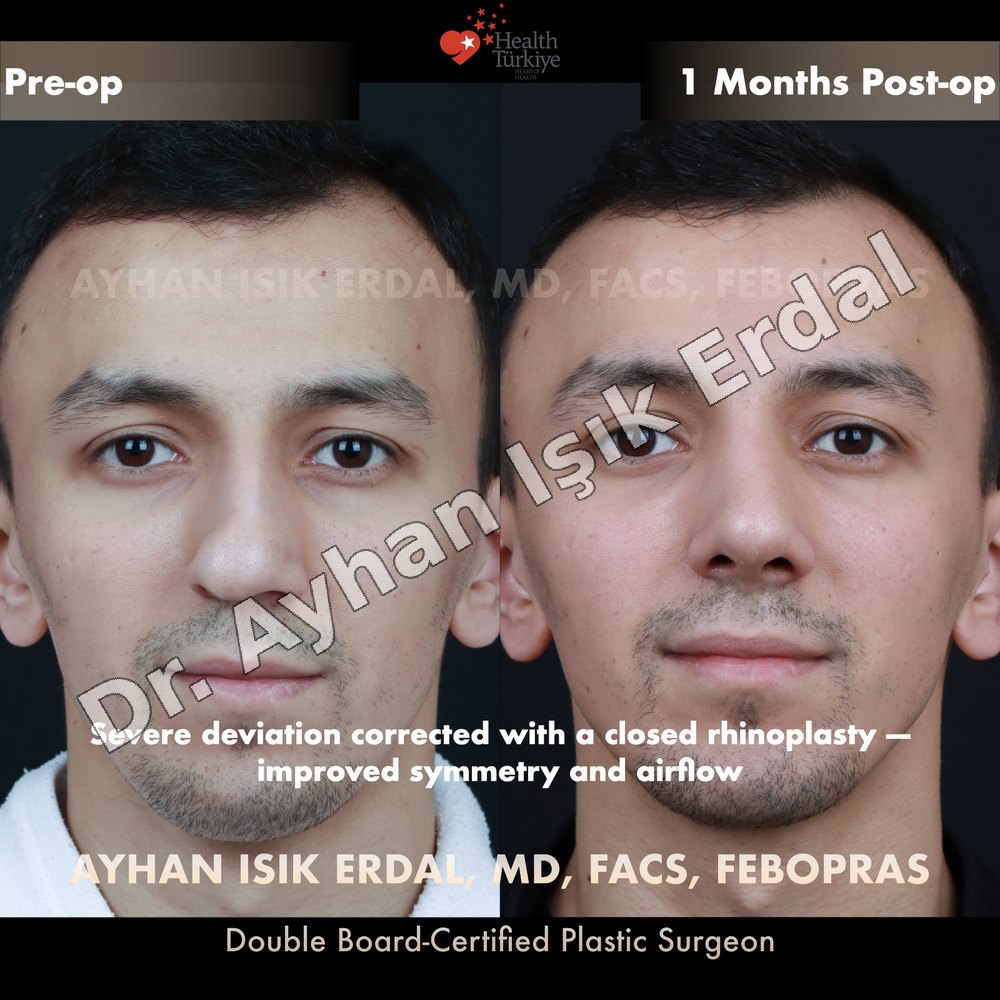 Rhinoplasty before-and-after result by Dr. Ayhan Işık Erdal, Istanbul