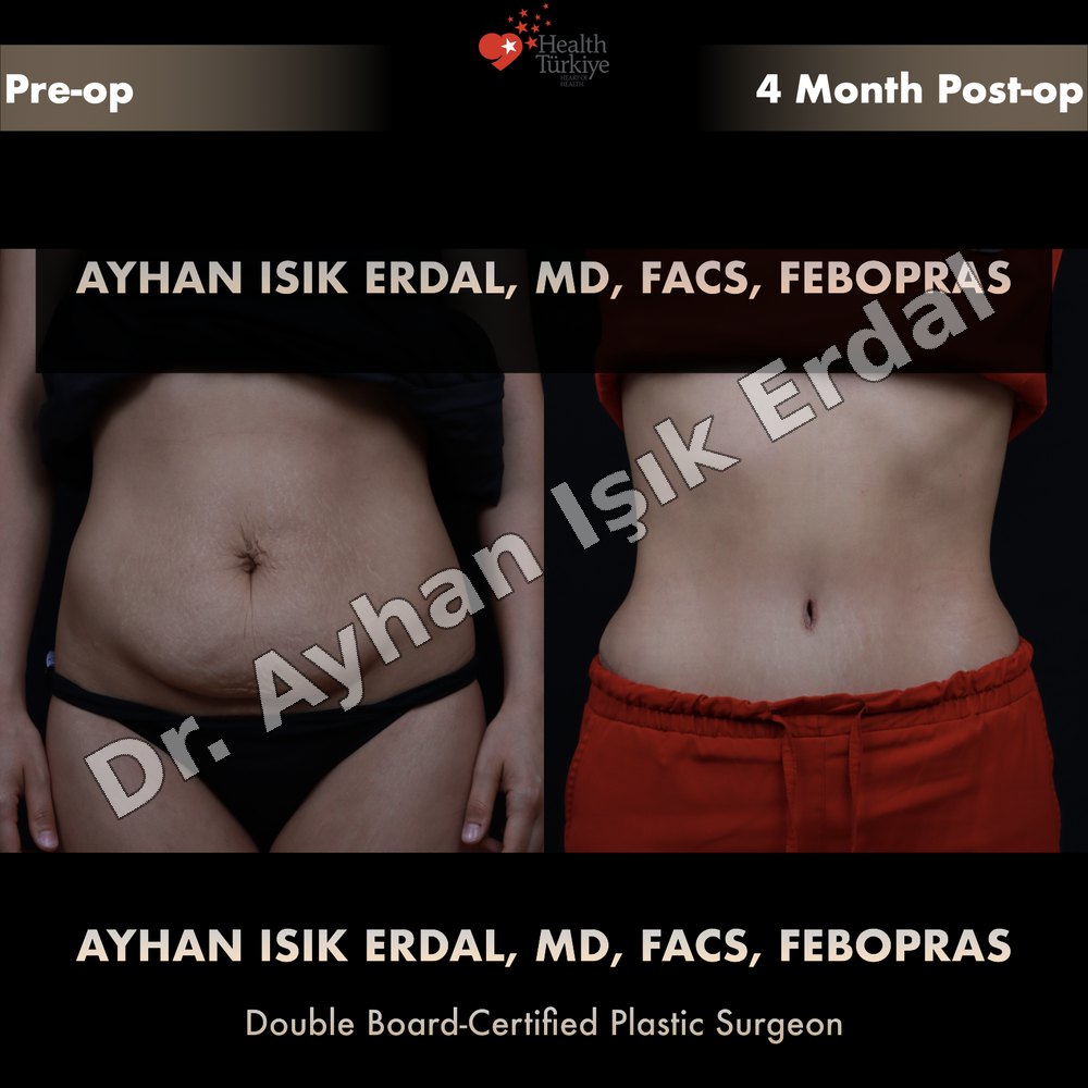 Tummy Tuck before-and-after result by Dr. Ayhan Işık Erdal, Istanbul